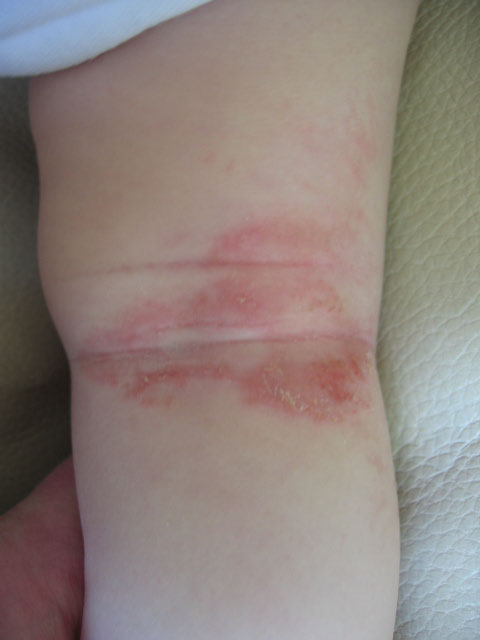 milk allergy