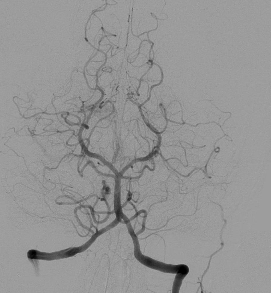 angiography