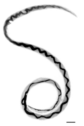 angiostrongyliasis