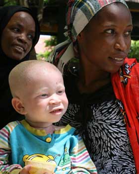 International Albinism Awareness Day