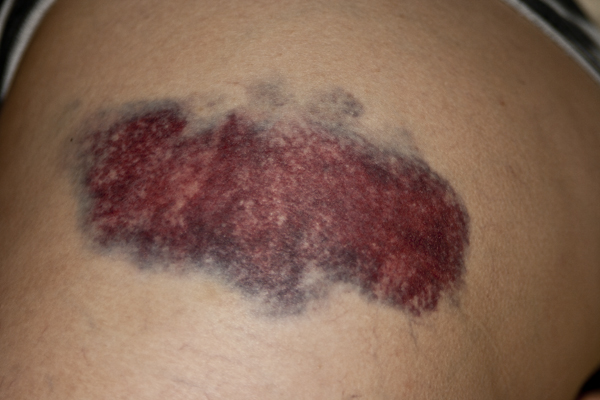 bruise