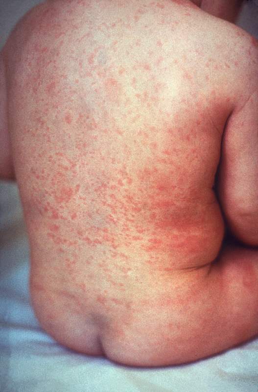 rubella
