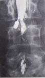 myelography