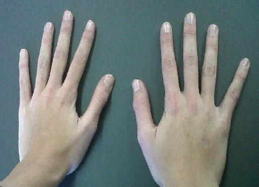arachnodactyly