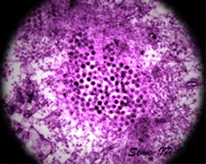 West Nile fever