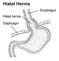 hiatus hernia