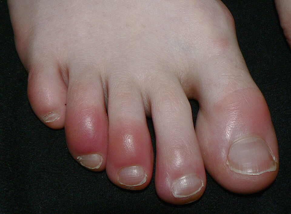 inflammation