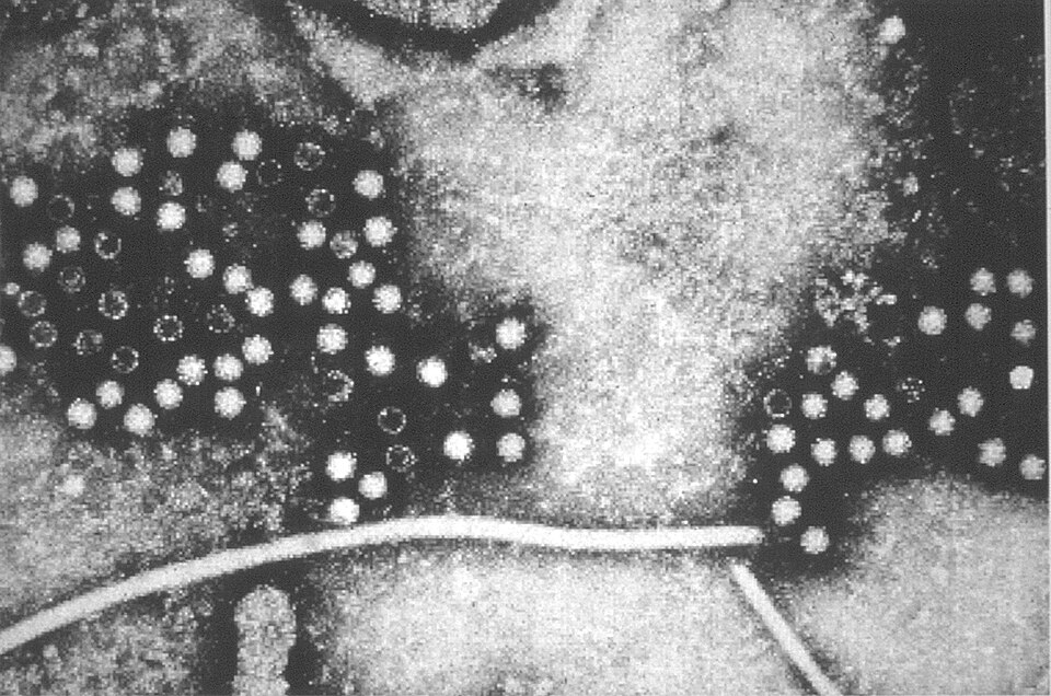 hepatitis E