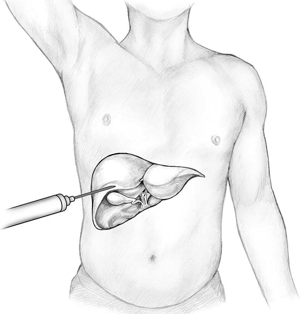 liver biopsy