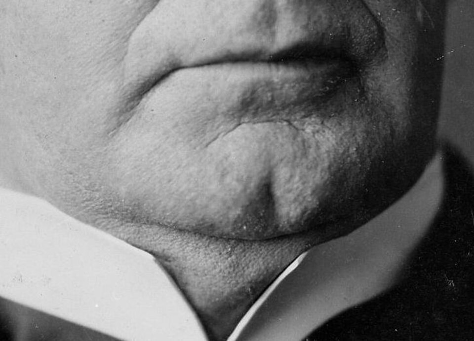 cleft chin