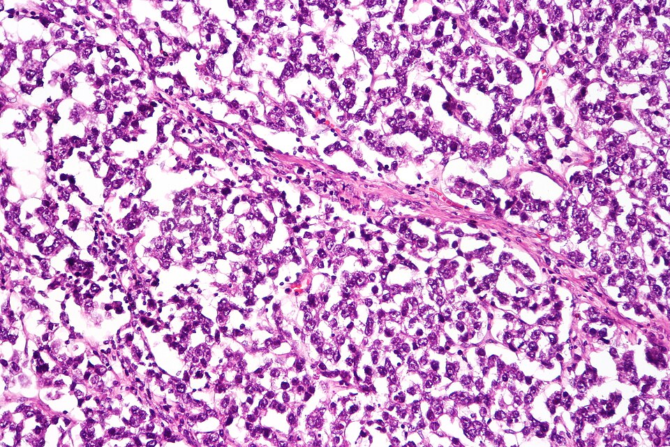 dysgerminoma