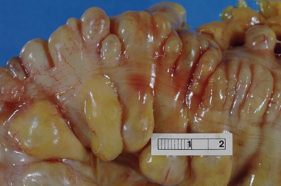 diverticulitis