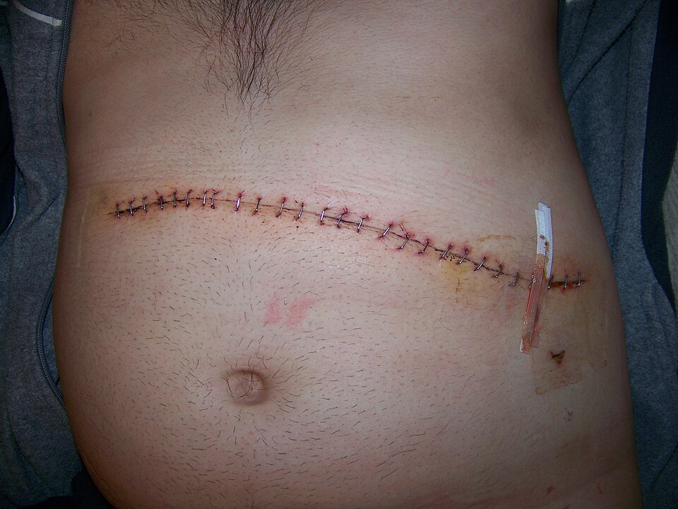 splenectomy