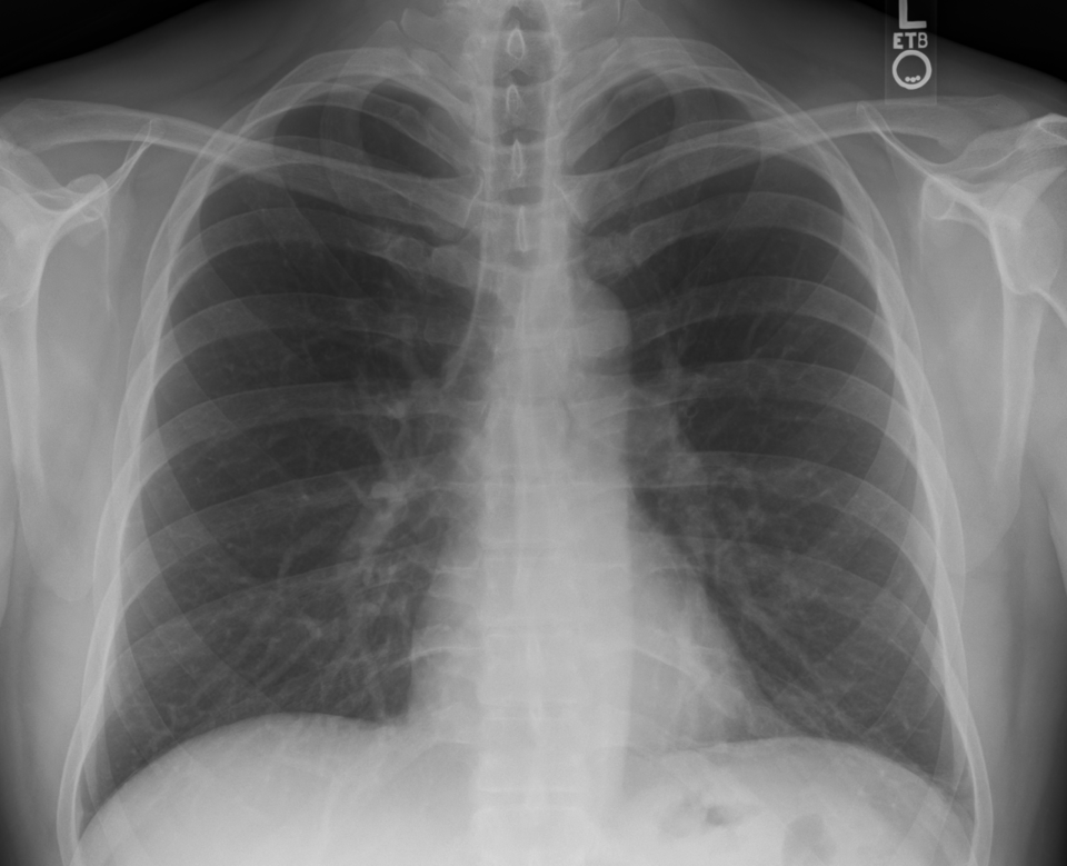 chest radiograph