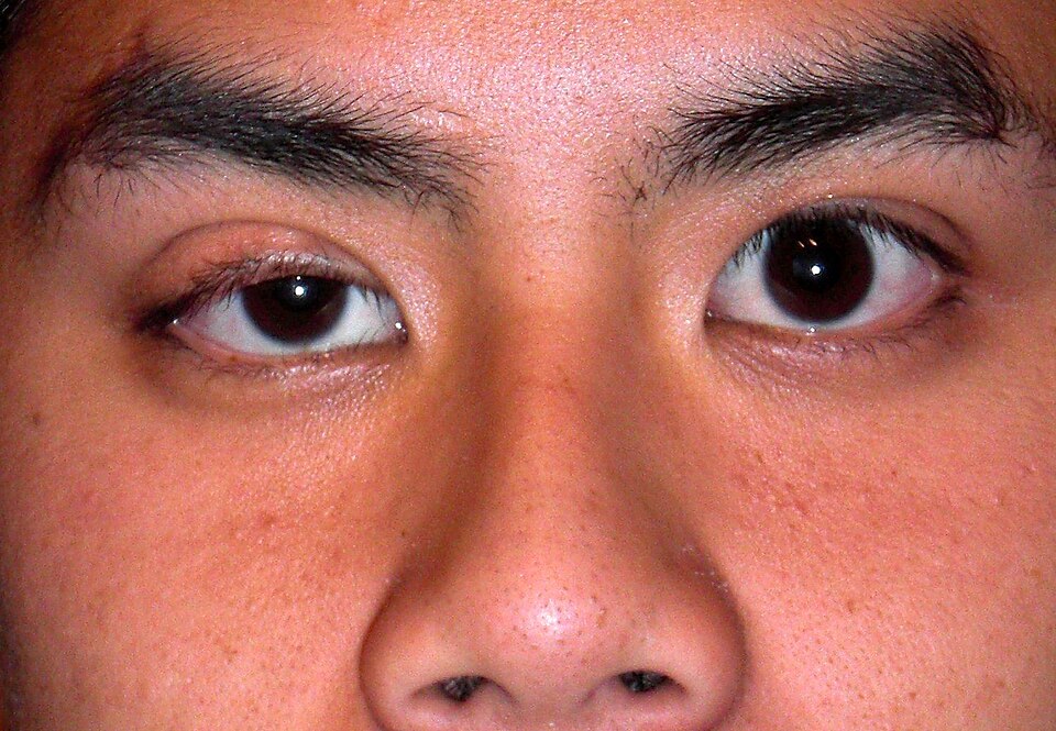 ptosis