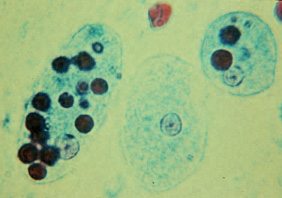 amebiasis
