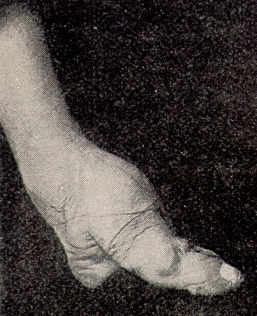 foot binding